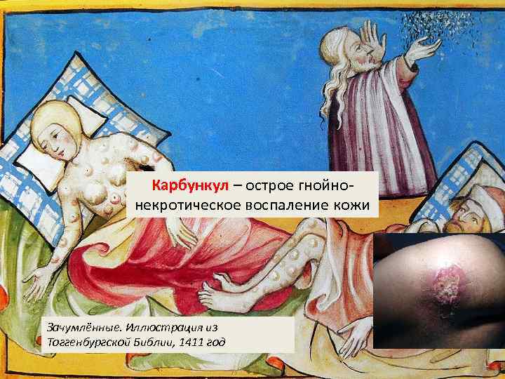 Карбункул – острое гнойнонекротическое воспаление кожи Зачумлённые. Иллюстрация из Тоггенбургской Библии, 1411 год 