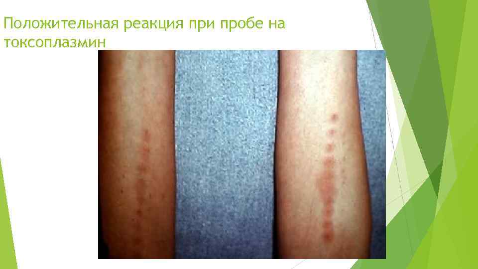 Положительная реакция при пробе на токсоплазмин 