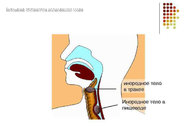 Íàðóøåíèå ïðîõîäèìîñòè äûõàòåëüíûõ ïóòåé инородное тело в трахее Инородное тело в пищеводе 