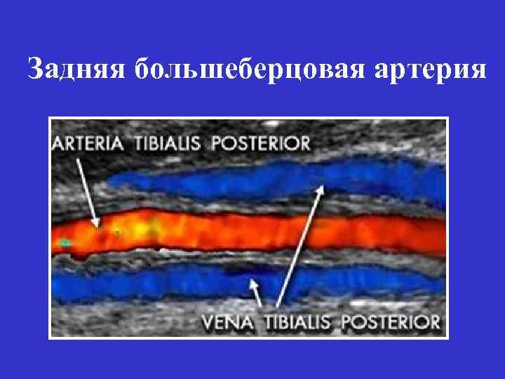 Задняя большеберцовая артерия 