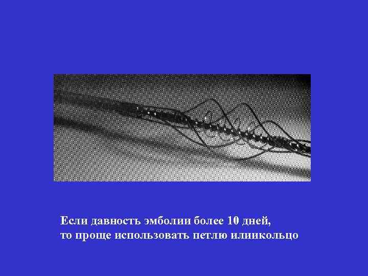 Если давность эмболии более 10 дней, то проще использовать петлю илиикольцо 