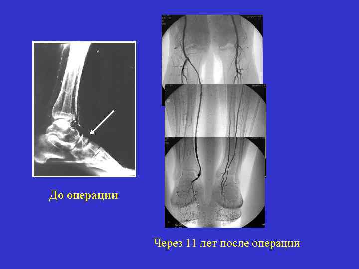 До операции Через 11 лет после операции 