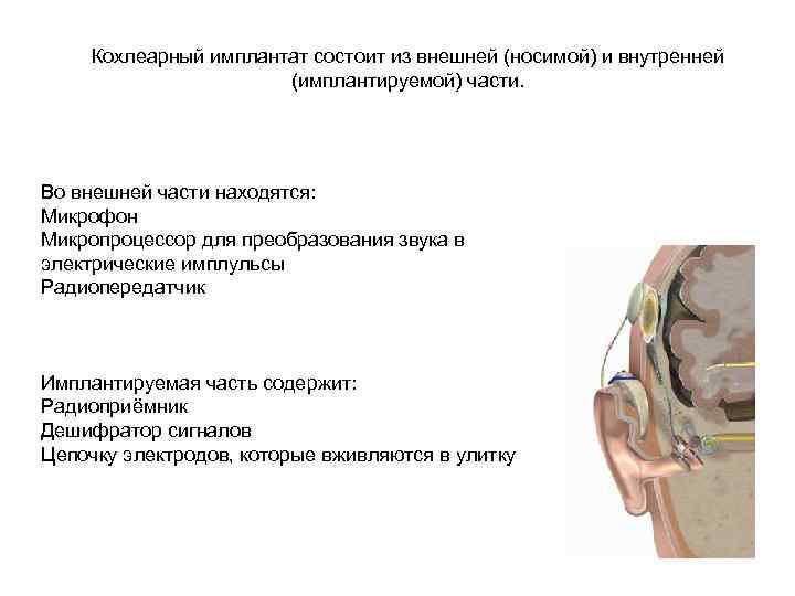 Кохлеарный имплантат состоит из внешней (носимой) и внутренней (имплантируемой) части. Во внешней части находятся: