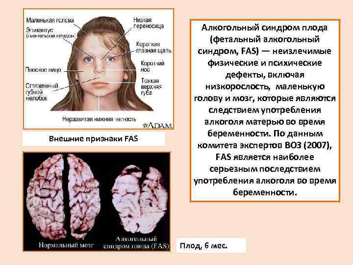Внешние признаки FAS Алкогольный синдром плода (фетальный алкогольный синдром, FAS) — неизлечимые физические и