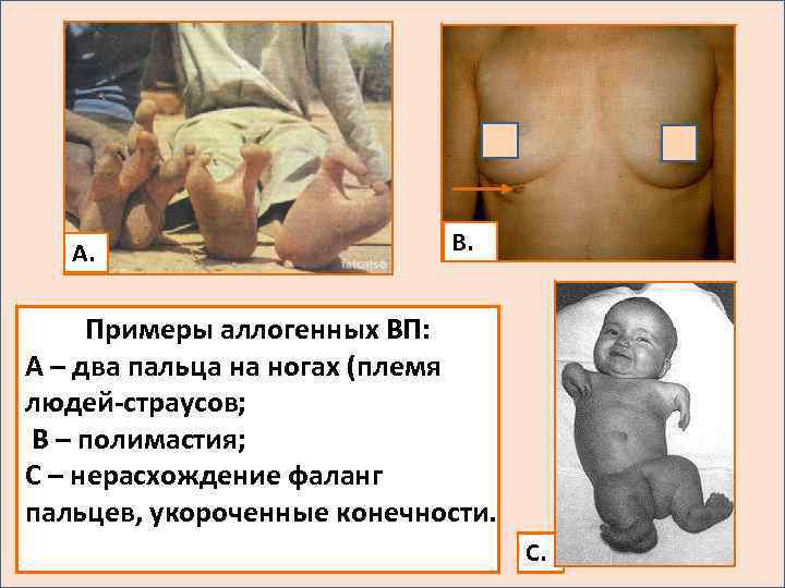 А. В. Примеры аллогенных ВП: А – два пальца на ногах (племя людей-страусов; В