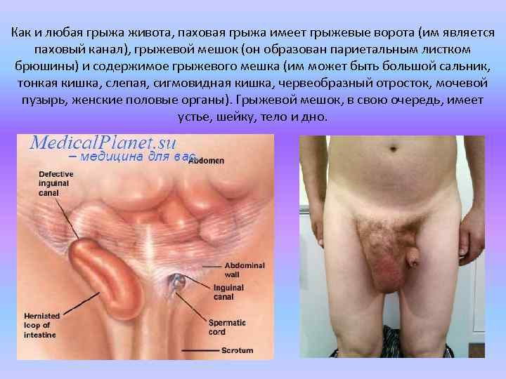 Как и любая грыжа живота, паховая грыжа имеет грыжевые ворота (им является паховый канал),