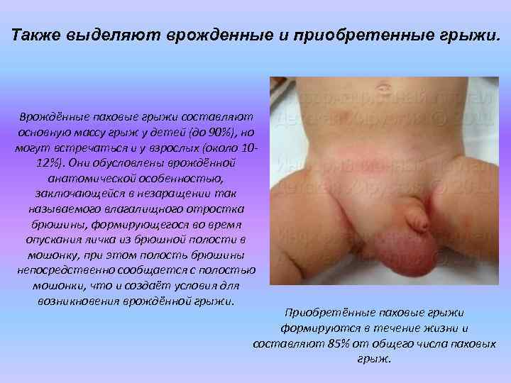 Также выделяют врожденные и приобретенные грыжи. Врождённые паховые грыжи составляют основную массу грыж у