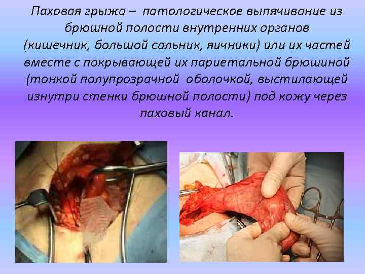 Паховая грыжа – патологическое выпячивание из брюшной полости внутренних органов (кишечник, большой сальник, яичники)