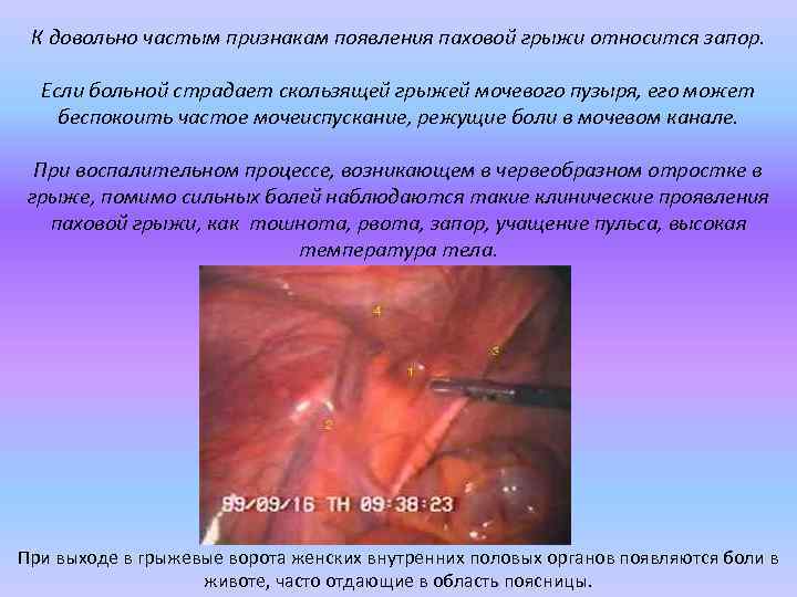 К довольно частым признакам появления паховой грыжи относится запор. Если больной страдает скользящей грыжей
