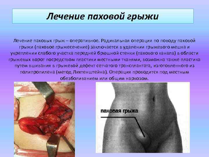 Лечение паховой грыжи Лечение паховых грыж – оперативное. Радикальная операция по поводу паховой грыжи