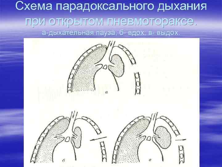 Схема парадоксального дыхания при открытом пневмотораксе. а-дыхательная пауза; б- вдох; в- выдох. 