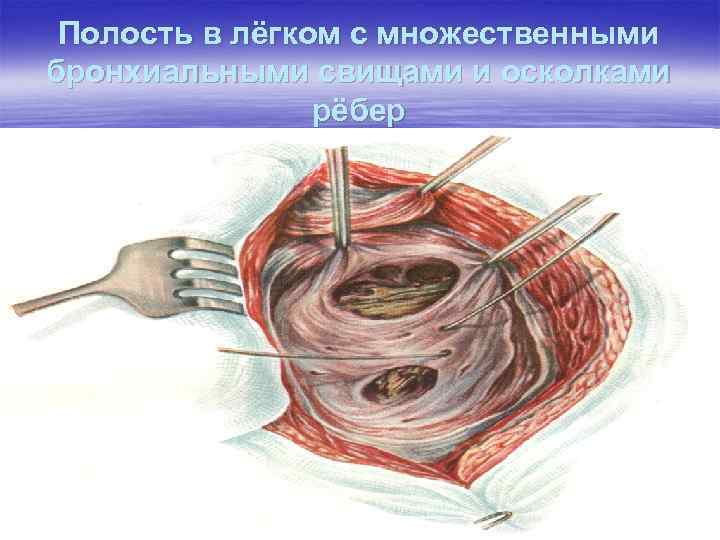 Полость в лёгком с множественными бронхиальными свищами и осколками рёбер 