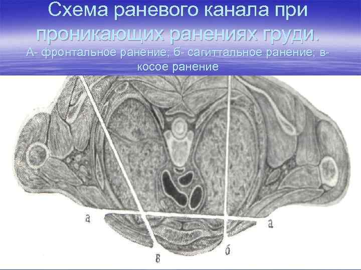 Схема раневого канала при проникающих ранениях груди. А- фронтальное ранение; б- сагиттальное ранение; вкосое