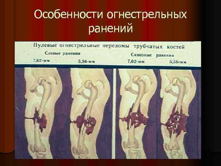 Особенности огнестрельных ранений 