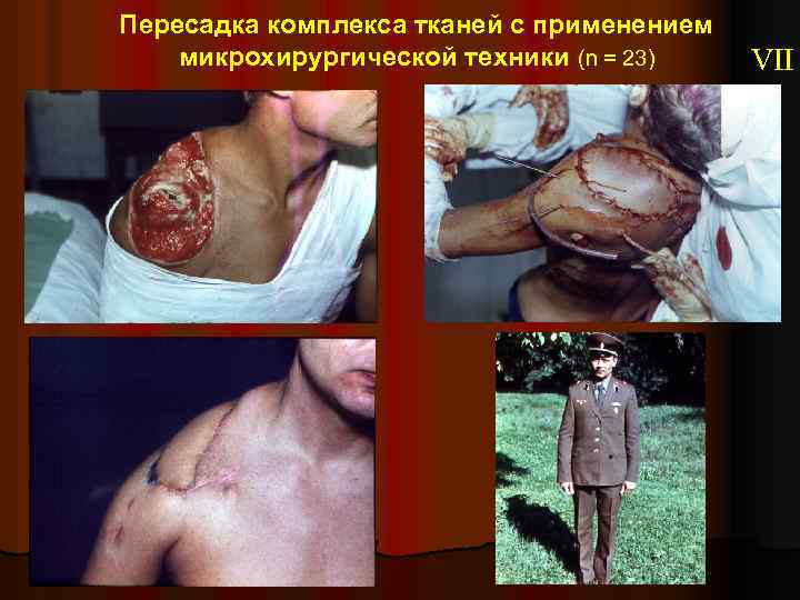 Пересадка комплекса тканей с применением микрохирургической техники (n = 23) VII 
