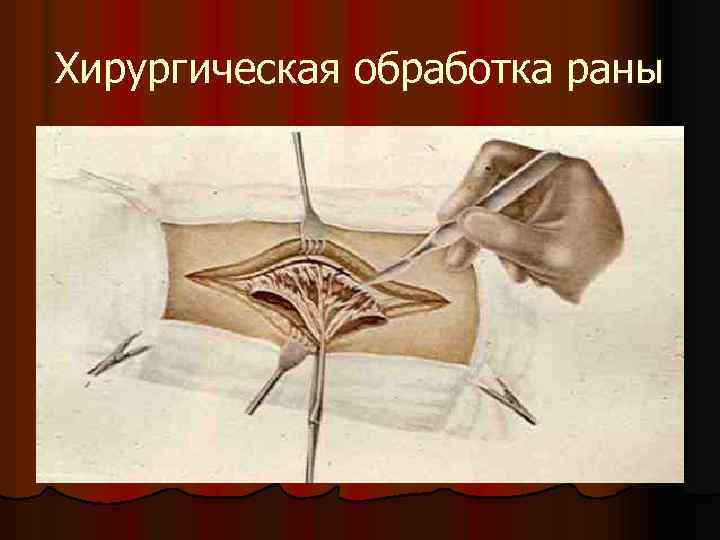 Хирургическая обработка раны 