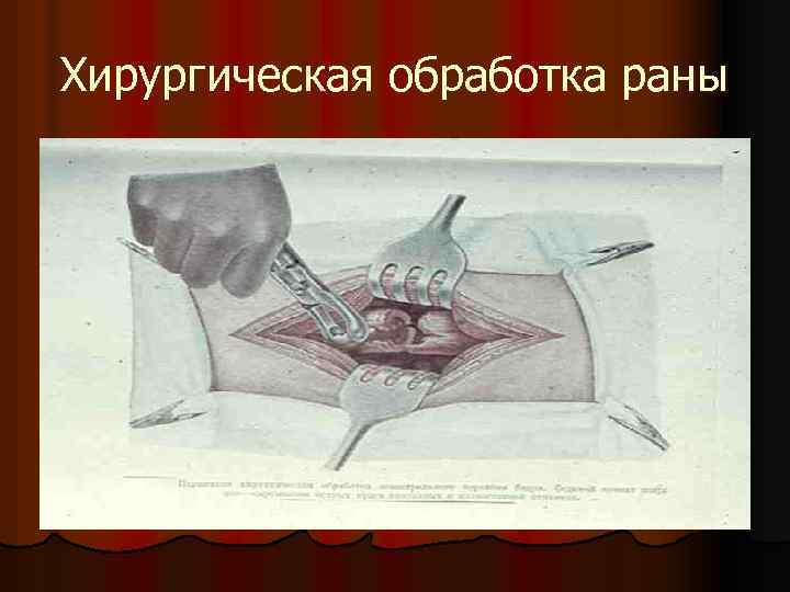 Хирургическая обработка раны 