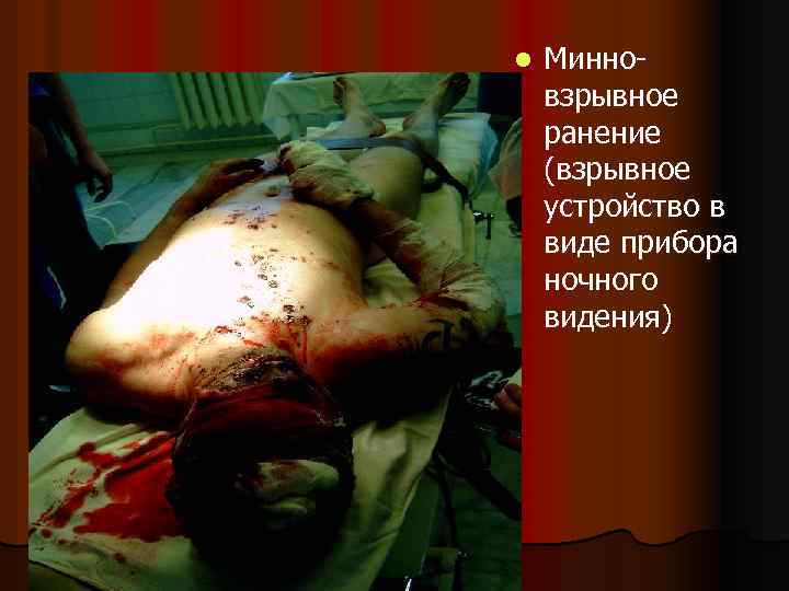 l Минновзрывное ранение (взрывное устройство в виде прибора ночного видения) 