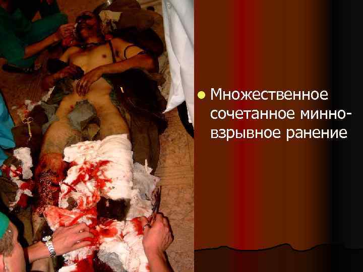 l Множественное сочетанное минновзрывное ранение 