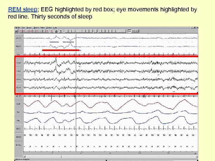 REM sleep; EEG highlighted by red box; eye movements highlighted by red line. Thirty