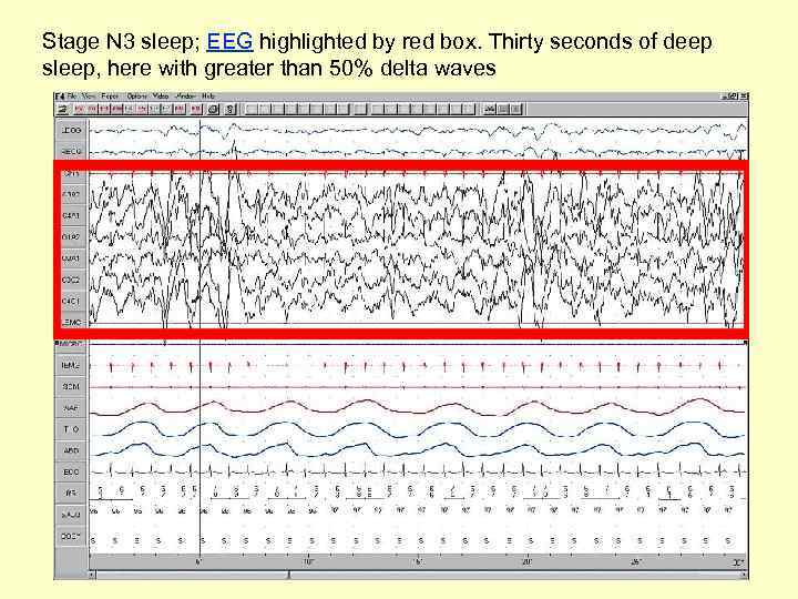 Stage N 3 sleep; EEG highlighted by red box. Thirty seconds of deep sleep,