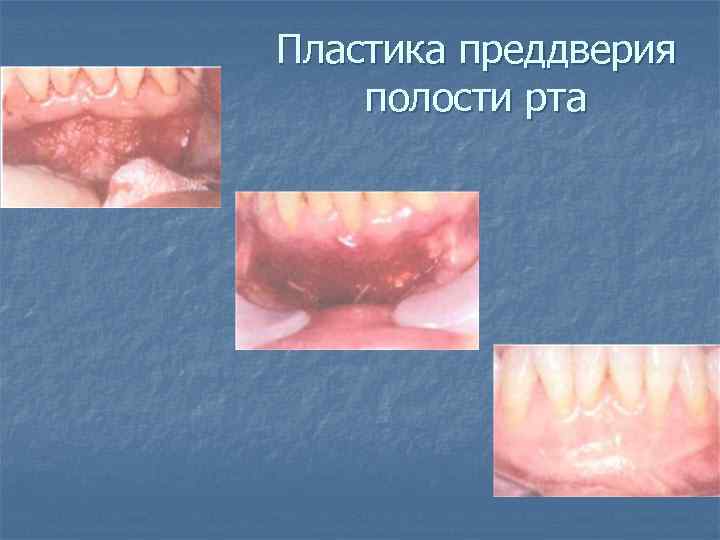 Пластика преддверия полости рта 