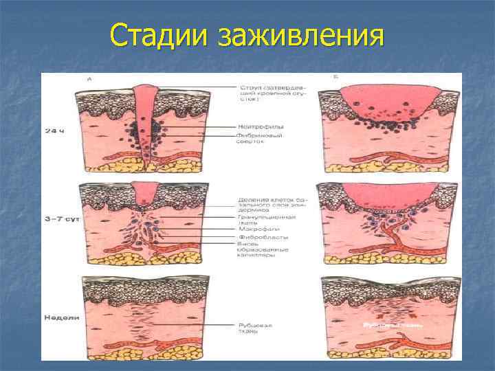 Заживление раны вторичным натяжением фото