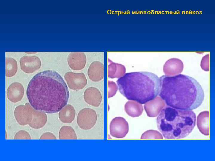 Острый миелобластный лейкоз фото