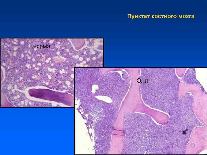 Пунктат костного мозга норма ОЛЛ 