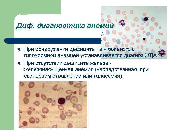 Диф. диагностика анемий l l При обнаружении дефицита Fe у больного с гипохромной анемией
