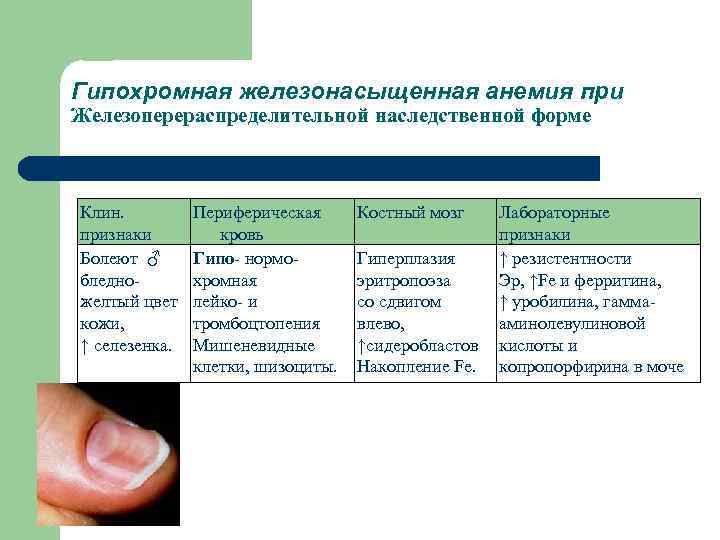 Гипохромная железонасыщенная анемия при Железоперераспределительной наследственной форме Клин. признаки Болеют ♂ бледно желтый цвет