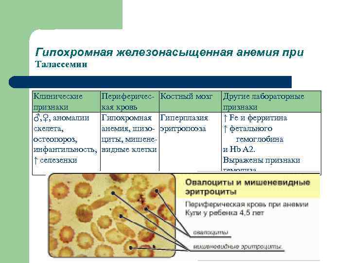 Гипохромная железонасыщенная анемия при Талассемии Клинические признаки ♂, ♀, аномалии скелета, остеопороз, инфантильность, ↑