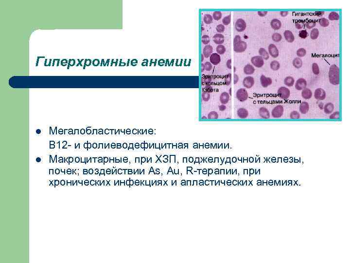 Гиперхромные анемии l l Мегалобластические: В 12 - и фолиеводефицитная анемии. Макроцитарные, при ХЗП,