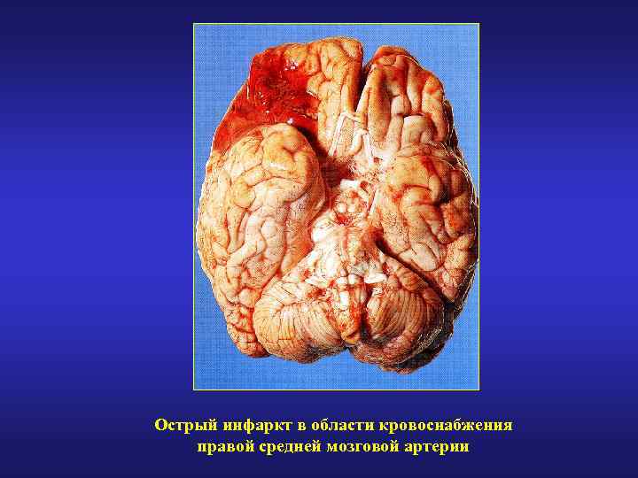Острый инфаркт в области кровоснабжения правой средней мозговой артерии 