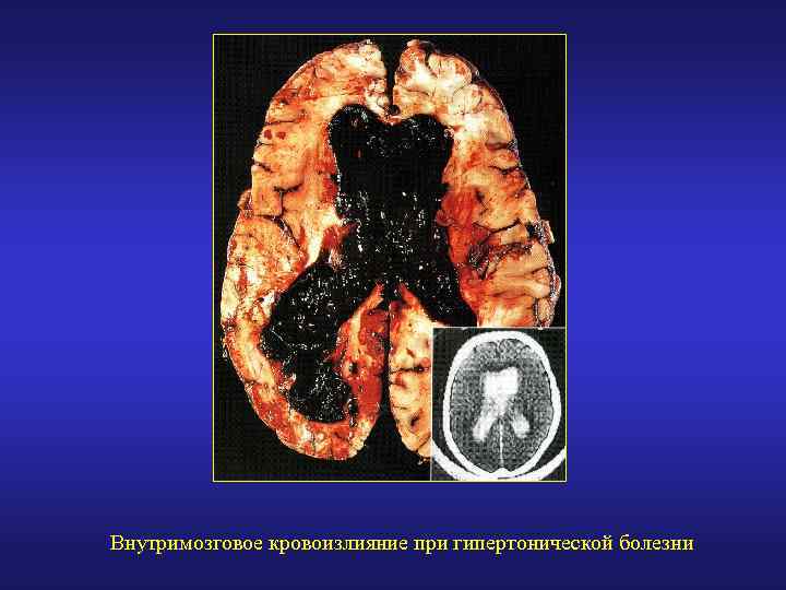Внутримозговое кровоизлияние при гипертонической болезни 