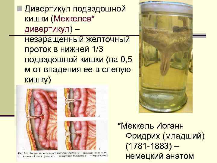 n Дивертикул подвздошной кишки (Меккелев* дивертикул) – незаращенный желточный проток в нижней 1/3 подвздошной