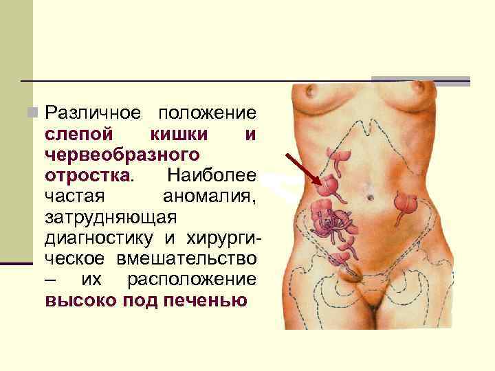 n Различное положение слепой кишки и червеобразного отростка. Наиболее частая аномалия, затрудняющая диагностику и