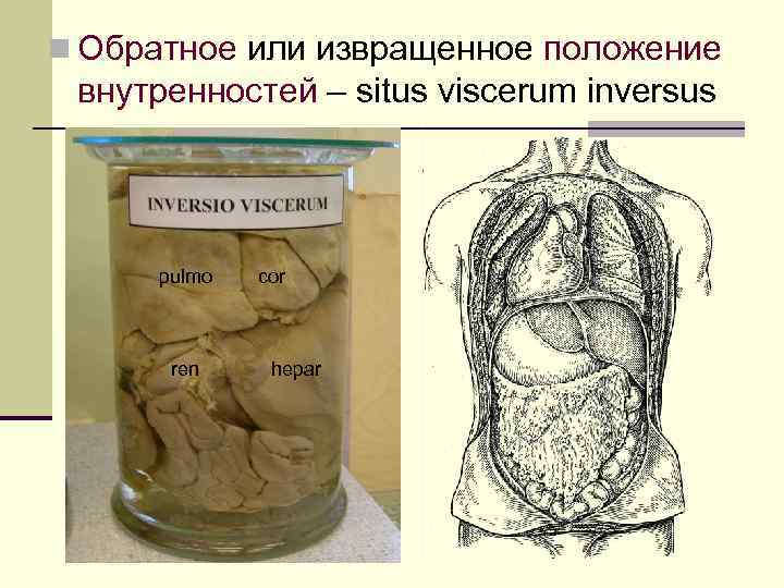n Обратное или извращенное положение внутренностей – situs viscerum inversus pulmo ren cor hepar