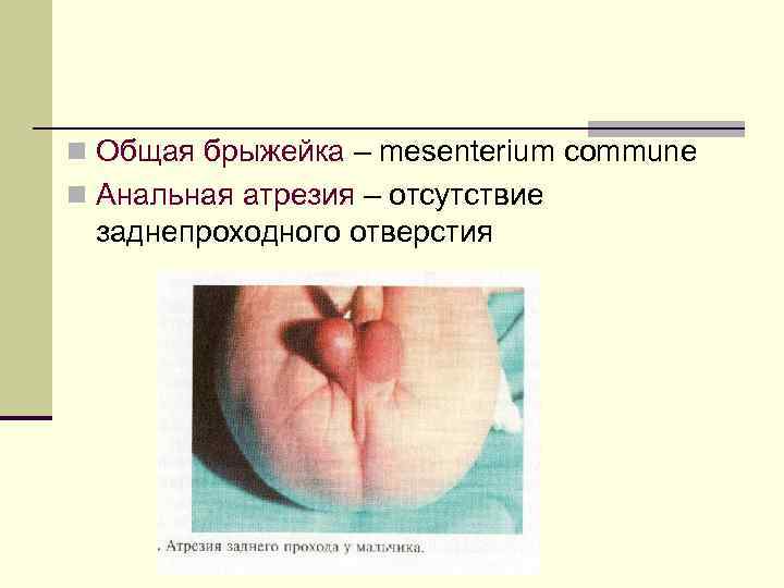 n Общая брыжейка – mesenterium commune n Анальная атрезия – отсутствие заднепроходного отверстия 