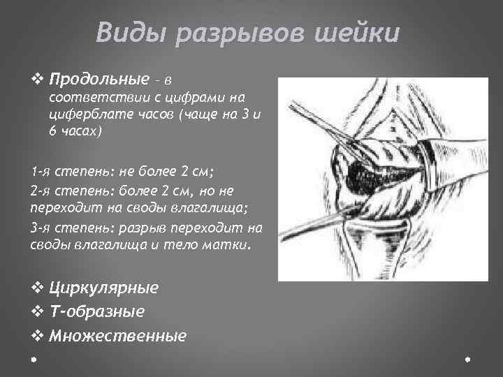 Виды разрывов шейки v Продольные – в соответствии с цифрами на циферблате часов (чаще