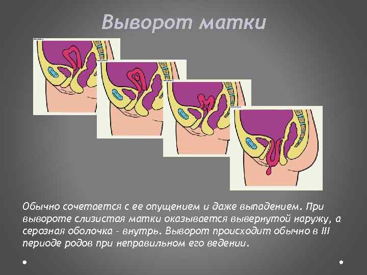 Как выглядит опущение матки на картинке