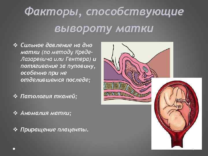 Факторы, способствующие вывороту матки v Сильное давление на дно матки (по методу Креде. Лазаревича