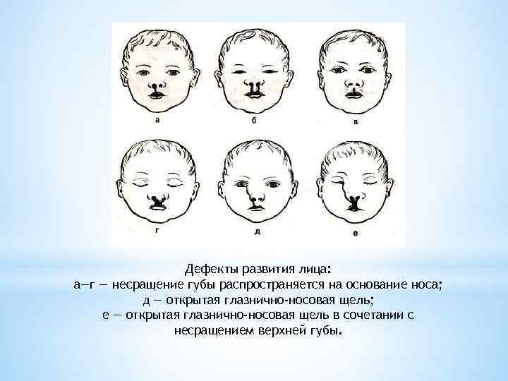 Дефекты развития лица: а—г — несращение губы распространяется на основание носа; д — открытая