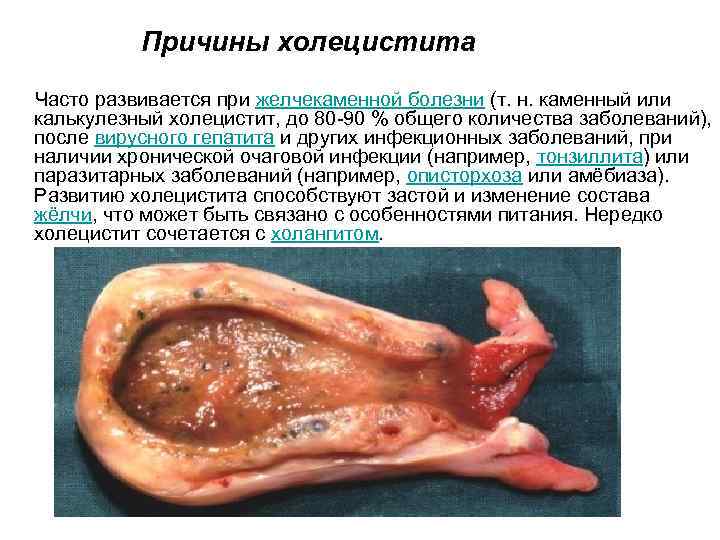 Стул при желчекаменной болезни