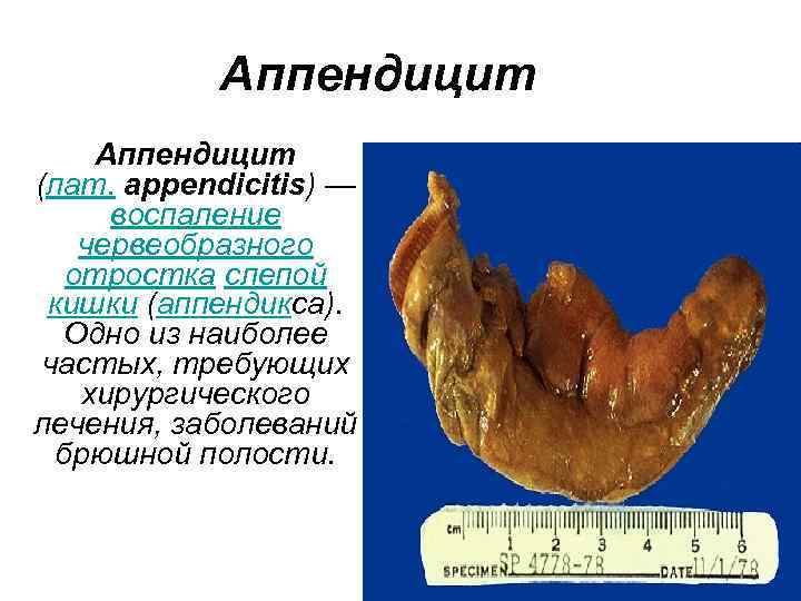 Аппендицит (лат. appendicitis) — воспаление червеобразного отростка слепой кишки (аппендикса). Одно из наиболее частых,