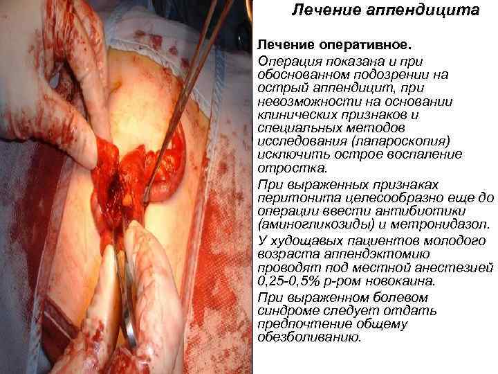  Лечение аппендицита Лечение оперативное. Операция показана и при обоснованном подозрении на острый аппендицит,