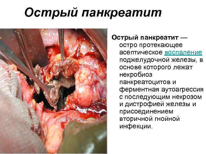 Острый панкреатит — остро протекающее асептическое воспаление поджелудочной железы, в основе которого лежат некробиоз