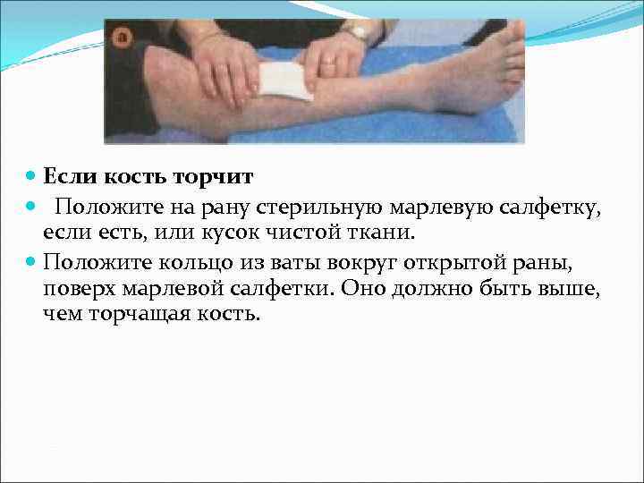  Если кость торчит Положите на рану стерильную марлевую салфетку, если есть, или кусок