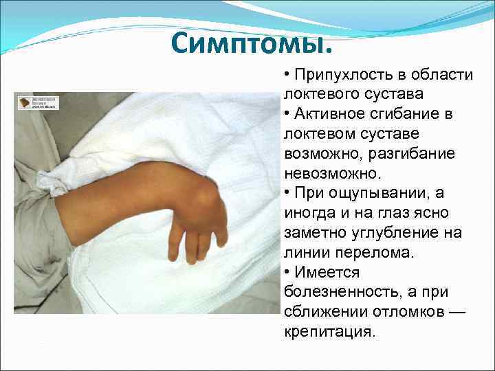 Симптомы. • Припухлость в области локтевого сустава • Активное сгибание в локтевом суставе возможно,