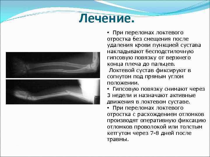 Лечение. • При переломах локтевого отростка без смещения после удаления крови пункцией сустава накладывают